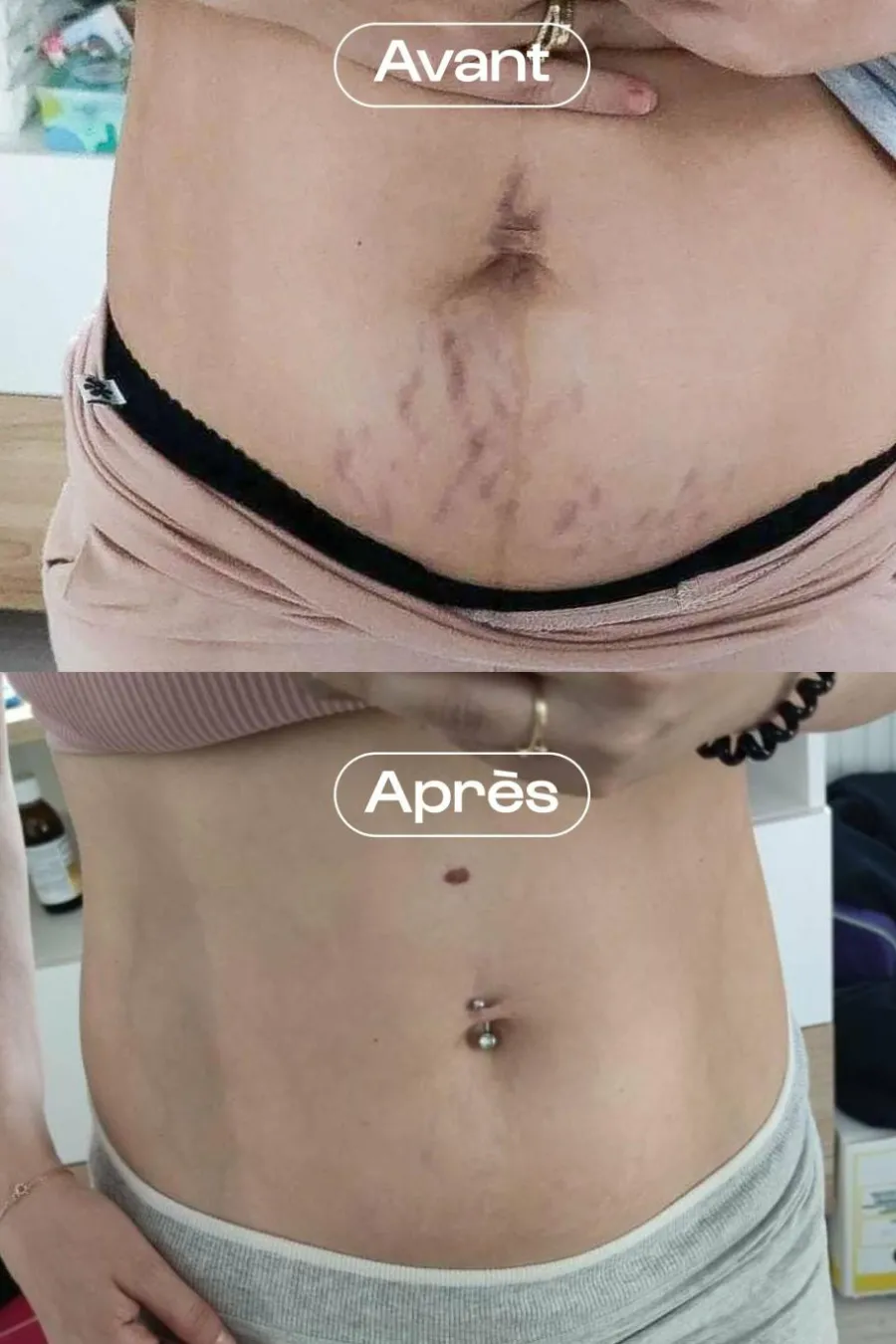 Clearance Concentré correcteur vergetures L’Expert Crème & Lait
