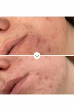 Hot Gel nettoyant purifiant Phaze Nettoyant Visage